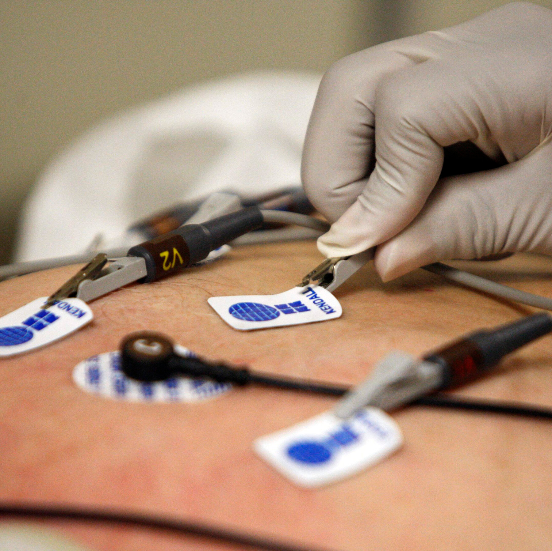 AI Detects Hidden Heart Conditions Missed by Traditional Methods